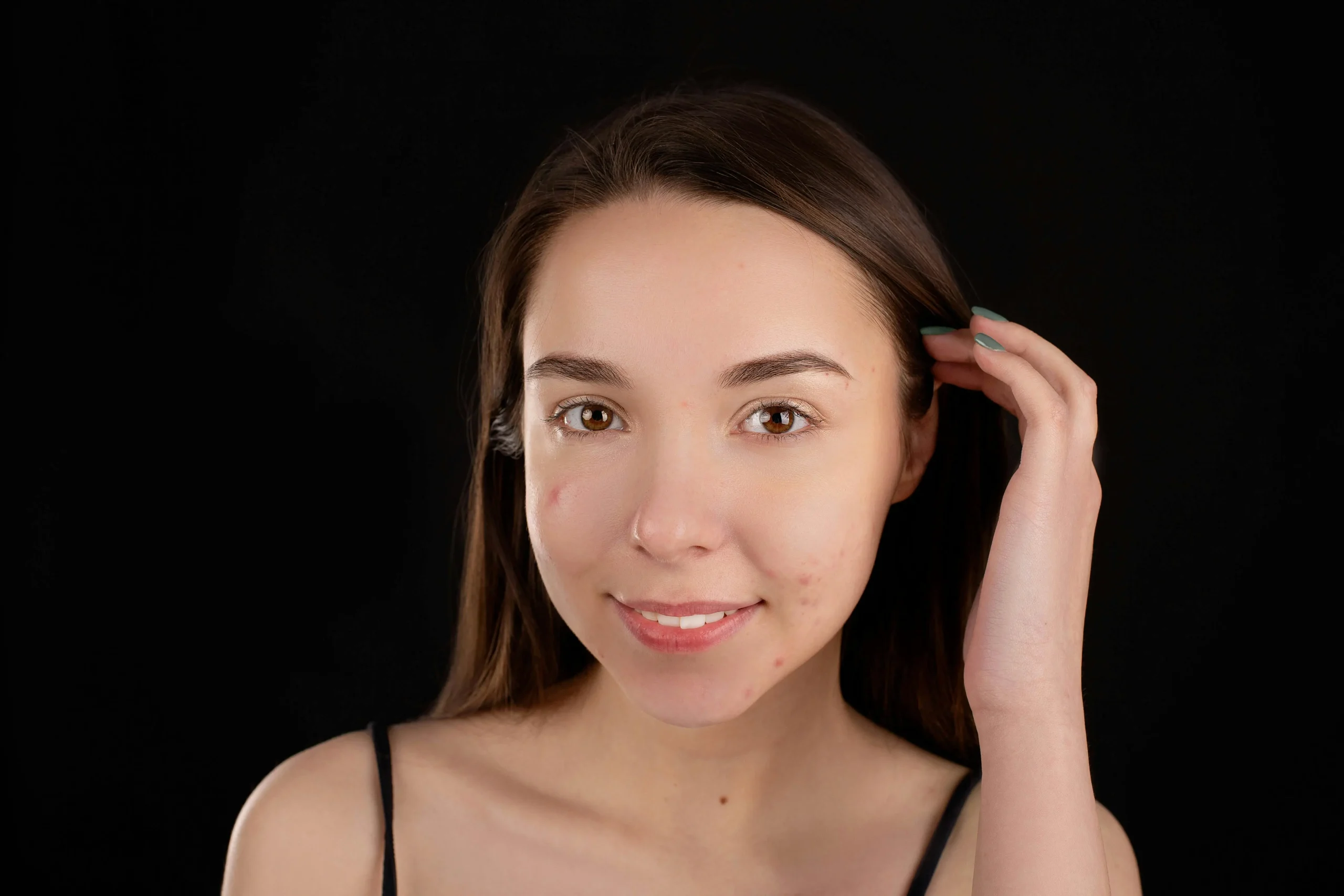 Combatting Acne Naturally: Holistic Approaches and Effective Treatments for Clearer Skin